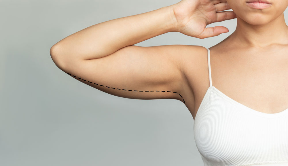 Who Is an Ideal Candidate for Arm Liposuction?