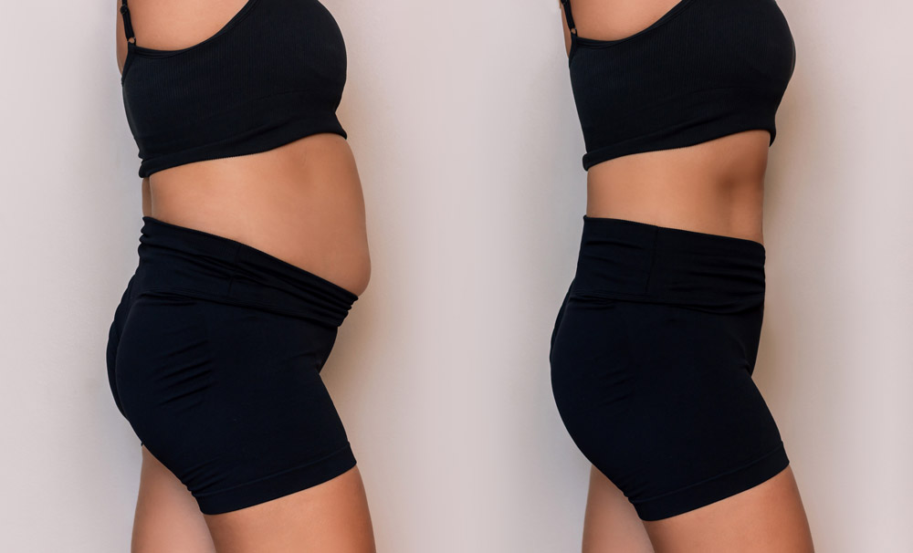 Why Choose Minimally Invasive Smart Liposuction?