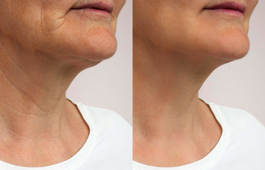 Benefits of Botox for Neck Bands at Perizia Aesthetics