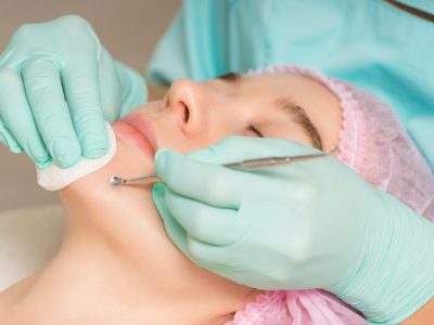 Acne Facial